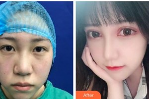 遵義韓美整形美容醫(yī)院彭楠整形價(jià)格表附切開(kāi)雙眼皮案例展示