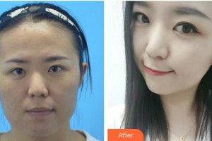 遵義利美康整形美容醫(yī)院邢云鵬整形價(jià)格表附隱形托槽矯正案例展示