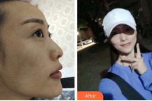 遵義紅美整形美容醫(yī)院仇軍整形價(jià)格表附激光祛斑案例展示