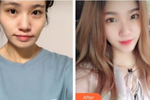 遵義利美康整形美容醫(yī)院何瑾整形價(jià)格表附埋線提升案例展示