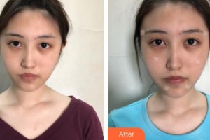 遵義喬雅菲醫(yī)療美容門(mén)診部賴(lài)炳文整形價(jià)格表附埋線提升案例展示