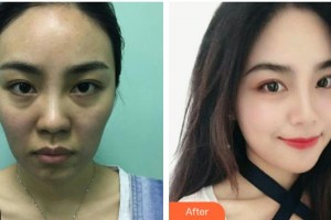 遵義醫(yī)學(xué)院附院美容醫(yī)院孫娜娜整形價(jià)格表附埋線提升案例展示