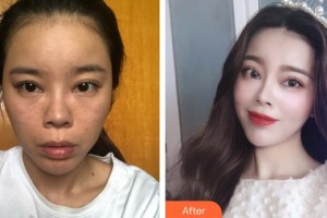 遵義韓美整形美容醫(yī)院柯茂華整形價(jià)格表附埋線提升案例展示