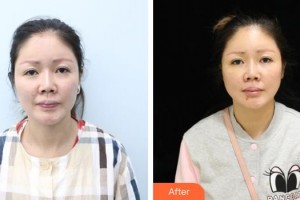 遵義利美康整形美容醫(yī)院唐芳明整形價(jià)格表附埋線提升案例展示