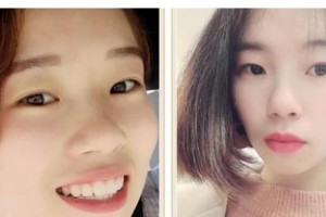 遵義利美康整形美容醫(yī)院徐普整形價(jià)格表附牙齒隱形矯正案例展示