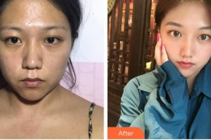 遵義韓美整形美容醫(yī)院羅艷紅整形價(jià)格表附激光祛斑案例展示