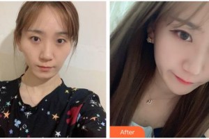 遵義韓美整形美容醫(yī)院代明星整形價(jià)格表附面部吸脂案例展示