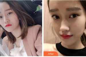 遵義利美康整形美容醫(yī)院朱豐整形價(jià)格表附牙齒隱形矯正案例展示