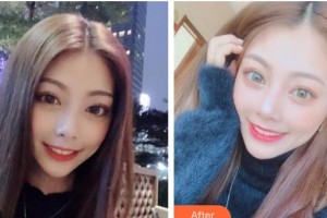 遵義利美康整形美容醫(yī)院安霞整形價格表附冷光美白案例展示