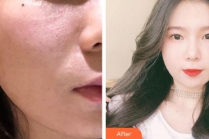 遵義現(xiàn)代皮膚病醫(yī)院劉雅楠整形價(jià)格表附彩光嫩膚案例展示