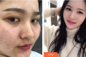 遵義喬雅菲醫(yī)療美容門(mén)診部羅碧強(qiáng)整形價(jià)格表附紅藍(lán)光祛痘案例展示