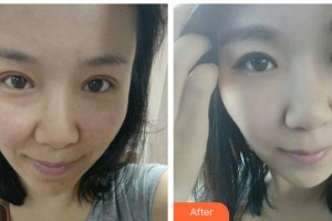 遵義現(xiàn)代皮膚病醫(yī)院陳炳全整形價格表附紅藍光祛痘案例展示