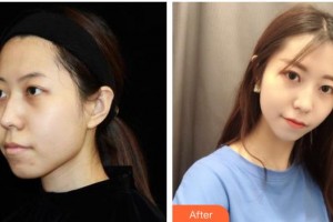 遵義韓美整形美容醫(yī)院吳靜整形價格表附光子嫩膚案例展示