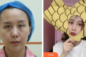 銅仁韓美時(shí)光醫(yī)療美容門診部胡曉波整形價(jià)格表附內(nèi)切祛眼袋案例展示