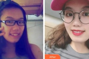 黔西南興義京州口腔醫(yī)院徐勇整形價(jià)格表附隱形托槽矯正案例展示