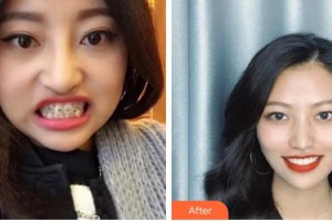 黔西南興義京州口腔醫(yī)院鄭六林整形價(jià)格表附牙齒陶瓷矯正案例展示