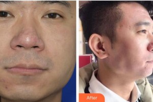 畢節(jié)市第一人民醫(yī)院燒傷整形外科張小林整形價(jià)格表附去痘印痘坑案例展示