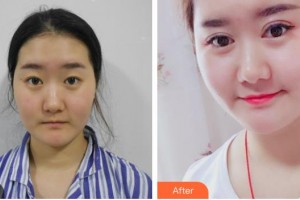 畢節(jié)陽明眼科醫(yī)院郝建整形價(jià)格表附眼部綜合案例展示