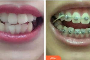 青?？等A整形醫(yī)院時(shí)林月整形價(jià)格表附金屬托槽矯正案例展示