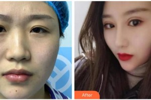 青?？等A整形醫(yī)院馮相周整形價(jià)格表附耳軟骨復(fù)合隆鼻案例展示