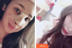 青?？等A整形醫(yī)院馬晶整形價(jià)格表附鼻部綜合案例展示