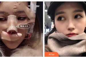 青?？等A整形醫(yī)院蔡志昆整形價(jià)格表附鼻部綜合案例展示