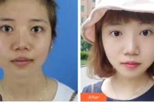 青?？等A整形醫(yī)院宋羽整形價(jià)格表附激光祛斑案例展示