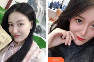 張家港康麗?？漆t(yī)院整形美容外科開學(xué)蘭住院醫(yī)師整形價(jià)格表附清潔祛痘案例展示