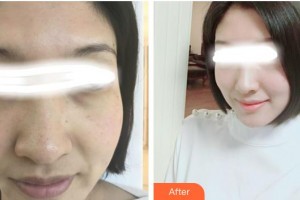 張家港康麗?？漆t(yī)院整形美容外科陸玉萍整形價(jià)格表附美白嫩膚案例展示