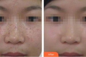 張家港唯恩醫(yī)療美容醫(yī)院鄭偉整形價(jià)格表附激光祛斑案例展示