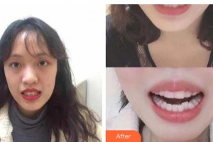 張家港康麗專科醫(yī)院整形美容外科范立國整形價(jià)格表附牙齒隱形矯正案例展示