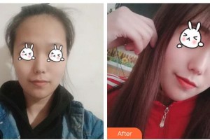 張家港唯恩醫(yī)療美容醫(yī)院蒯成官整形價(jià)格表附光子嫩膚案例展示