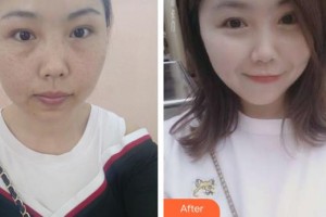 張家港吳寶紅醫(yī)療美容診所吳寶紅整形價(jià)格表附激光祛斑案例展示