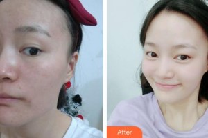 張家港容麗妍醫(yī)療美容門診部許紅麗整形價(jià)格表附去痘印痘坑案例展示