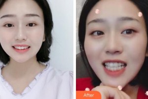 張家港康麗?？漆t(yī)院整形美容外科劉勝整形價(jià)格表附牙齒隱形矯正案例展示