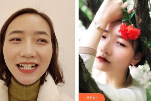 武警廣西總隊(duì)醫(yī)院醫(yī)學(xué)整形美容中心林瓏整形價(jià)格表附牙齒隱形矯正案例展示