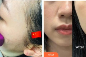 武警廣西總隊(duì)醫(yī)院醫(yī)學(xué)整形美容中心張樹芳 整形價(jià)格表附熱瑪吉案例展示