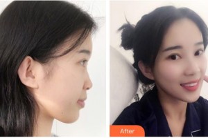 廣西東方整形美容醫(yī)院仇侃敏整形價(jià)格表附鼻部綜合案例展示