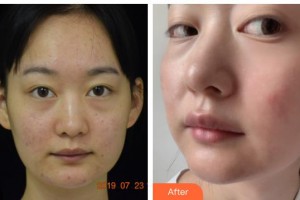 廣西醫(yī)科大學(xué)美容整形中心韋潔整形價(jià)格表附去痘印痘坑案例展示