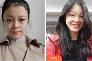 廣西愛(ài)思特整形外科醫(yī)院肖翔轅整形價(jià)格表附微針美膚案例展示