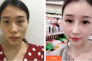 廣西愛(ài)思特整形外科醫(yī)院李俊明整形價(jià)格表附鼻部綜合案例展示