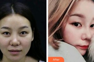 武警廣西總隊(duì)醫(yī)院醫(yī)學(xué)整形美容中心孫周映整形價(jià)格表附鼻部綜合案例展示