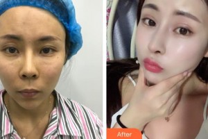 武警廣西總隊(duì)醫(yī)院醫(yī)學(xué)整形美容中心陳笑整形價(jià)格表附鼻修復(fù)案例展示