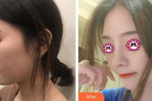 武警廣西總隊(duì)醫(yī)院醫(yī)學(xué)整形美容中心尹熙根整形價(jià)格表附肋軟骨隆鼻案例展示