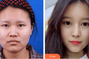 廣西中醫(yī)院第一附屬醫(yī)院美膚激光整形美容科李紅陽(yáng)整形價(jià)格表附鼻部綜合案例展示