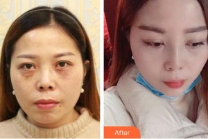 廣西東方整形美容醫(yī)院周憶芬整形價(jià)格表附鼻部綜合案例展示