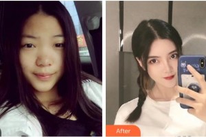 廣西中醫(yī)院第一附屬醫(yī)院美膚激光整形美容科梁桂枝整形價(jià)格表附鼻部綜合案例展示