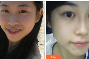 廣西中醫(yī)院第一附屬醫(yī)院美膚激光整形美容科李昌儀整形價(jià)格表附鼻部綜合案例展示