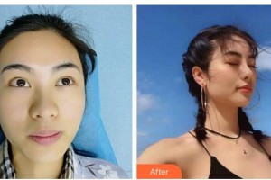 廣西醫(yī)科大學(xué)第一附屬醫(yī)院整形美容科劉達(dá)恩整形價(jià)格表附鼻部綜合案例展示