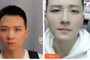 廣西醫(yī)科大學(xué)第一附屬醫(yī)院整形美容科王潤秀整形價格表附鼻部綜合案例展示